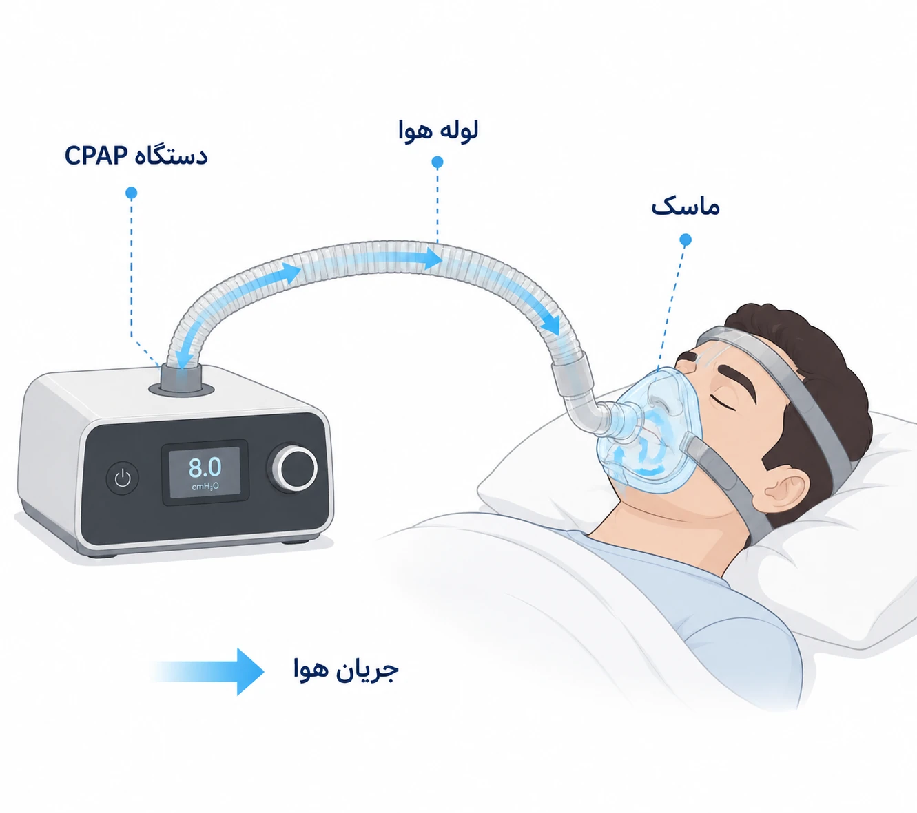 نحوه عملکرد دستگاه CPAP در باز نگه داشتن راه هوایی - مقایسه راه هوایی باز و بسته در خواب