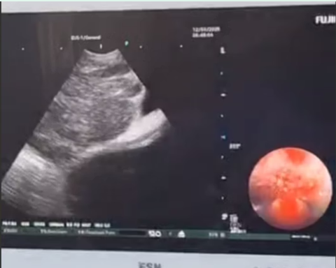 سونوگرافی اندوبرونکیال EBUS